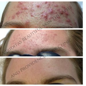 Viriditas Beautiful Skin Therapies_ Providence Acne Clinic(3)