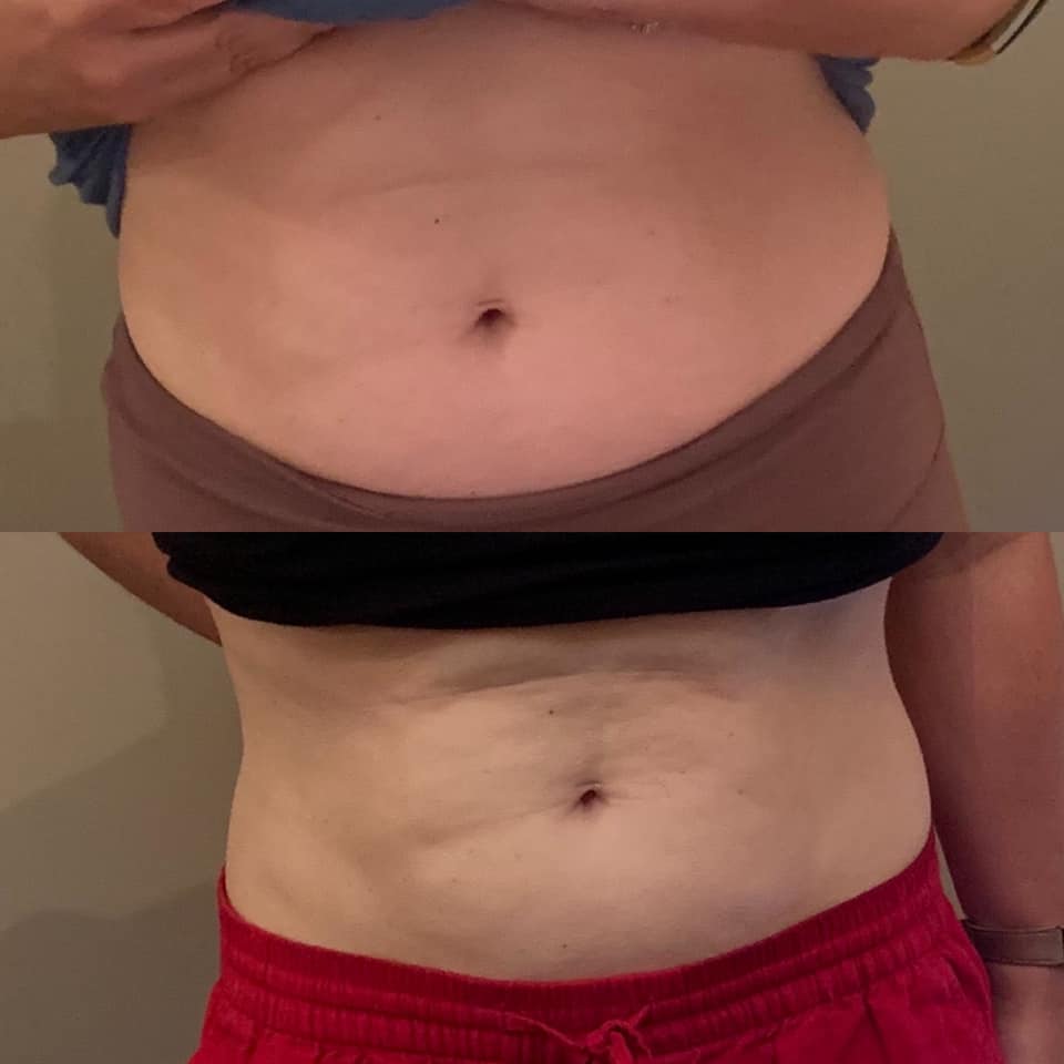 Before and After 1 Slimming and 1 ToningTreatment