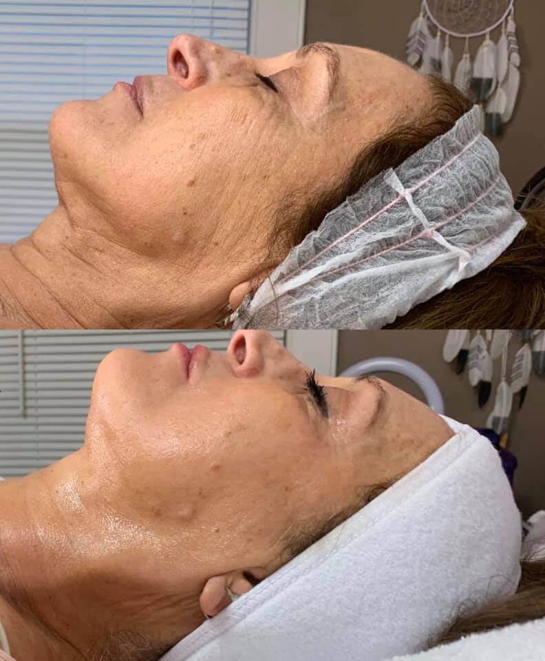 before and after 3 facial toning treatments