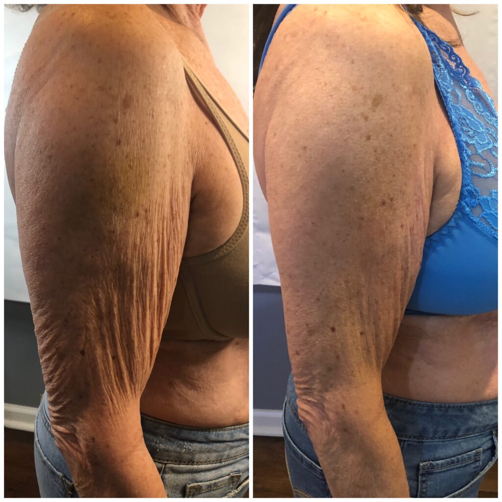 side view, before and after 4 toning arm treatments