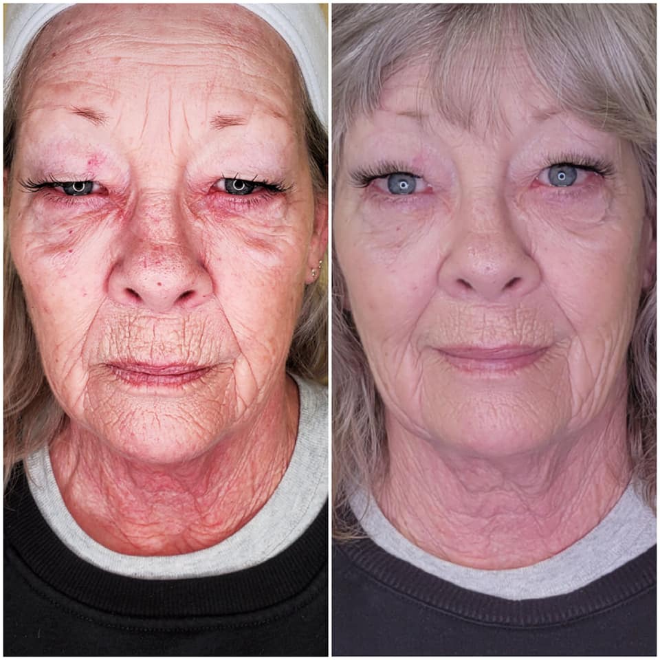 6 weeks after 6 facial toning treatments