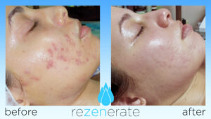 before and after acne scarring with Rezenerate facial nanofacial treatment
