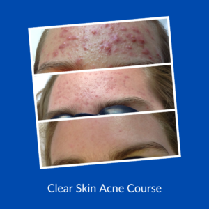 acne treatment online course header/ before and after acne client