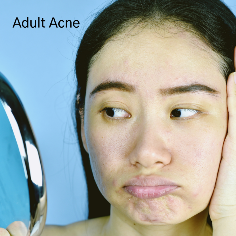 adult with acne looking in mirror, pouting