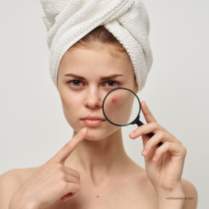 a young woman points to a red blemiah on her sheek that is highlighted with a magnifying glass