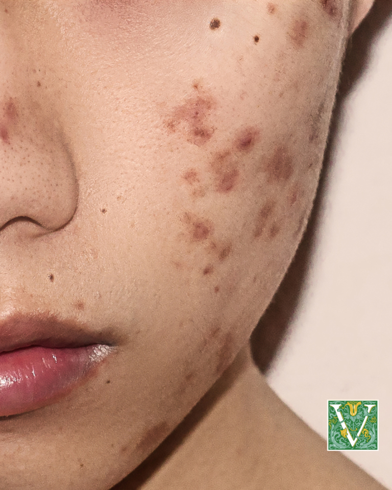 close up of cheek with acne scars, PIE and PIH