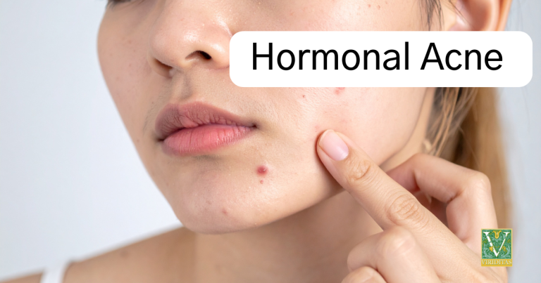 Hormonal Acne closeup of woman with acne breakout on her chin